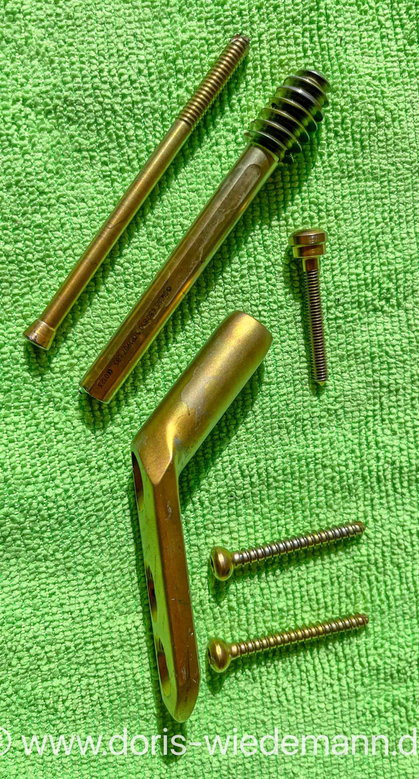 Implants from a femoral neck fracture: dynamic screw plus plate plus screws